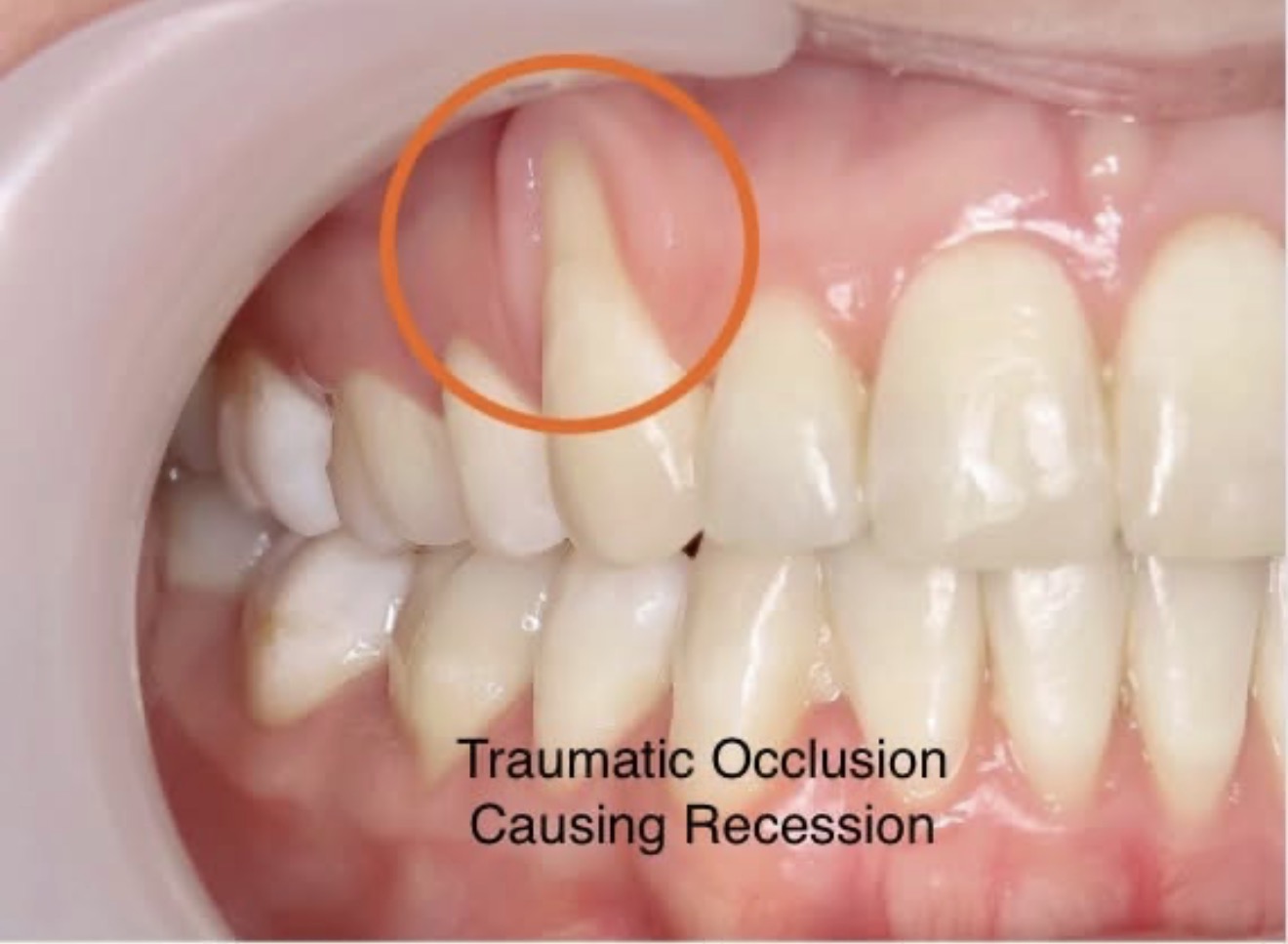 Why Gums Recede: The Real Causes