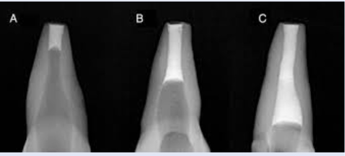 What Is Put Inside a Root Canal Tooth, and Is It Safe?