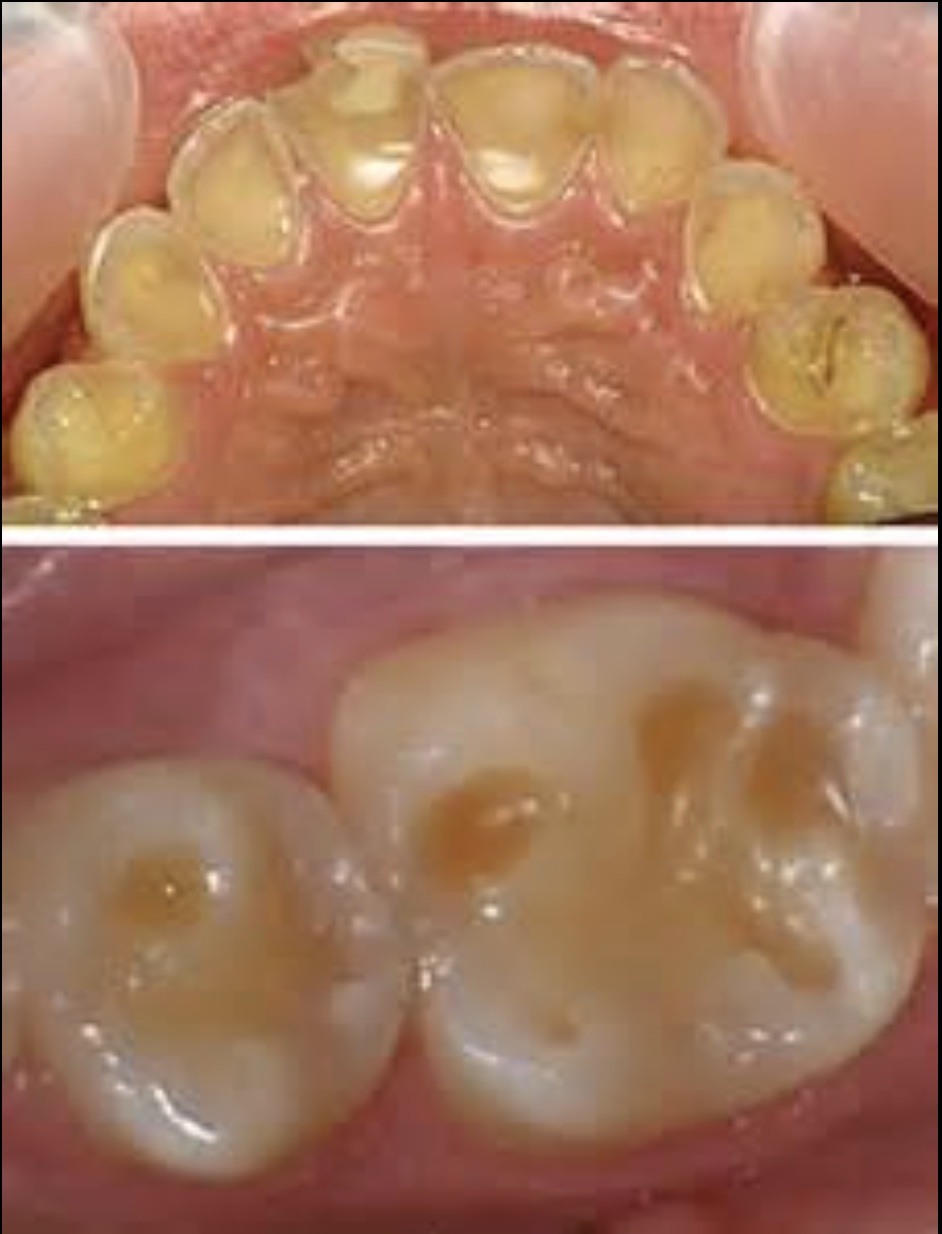 Bulimia, Reflux and Teeth Damage: When Acid Meets Enamel