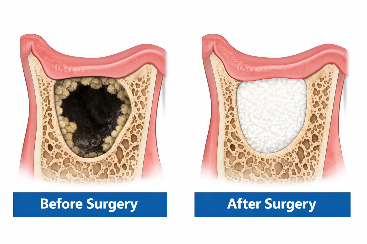 What Is a Jawbone Cavitation? Hidden Infection in the Jaw