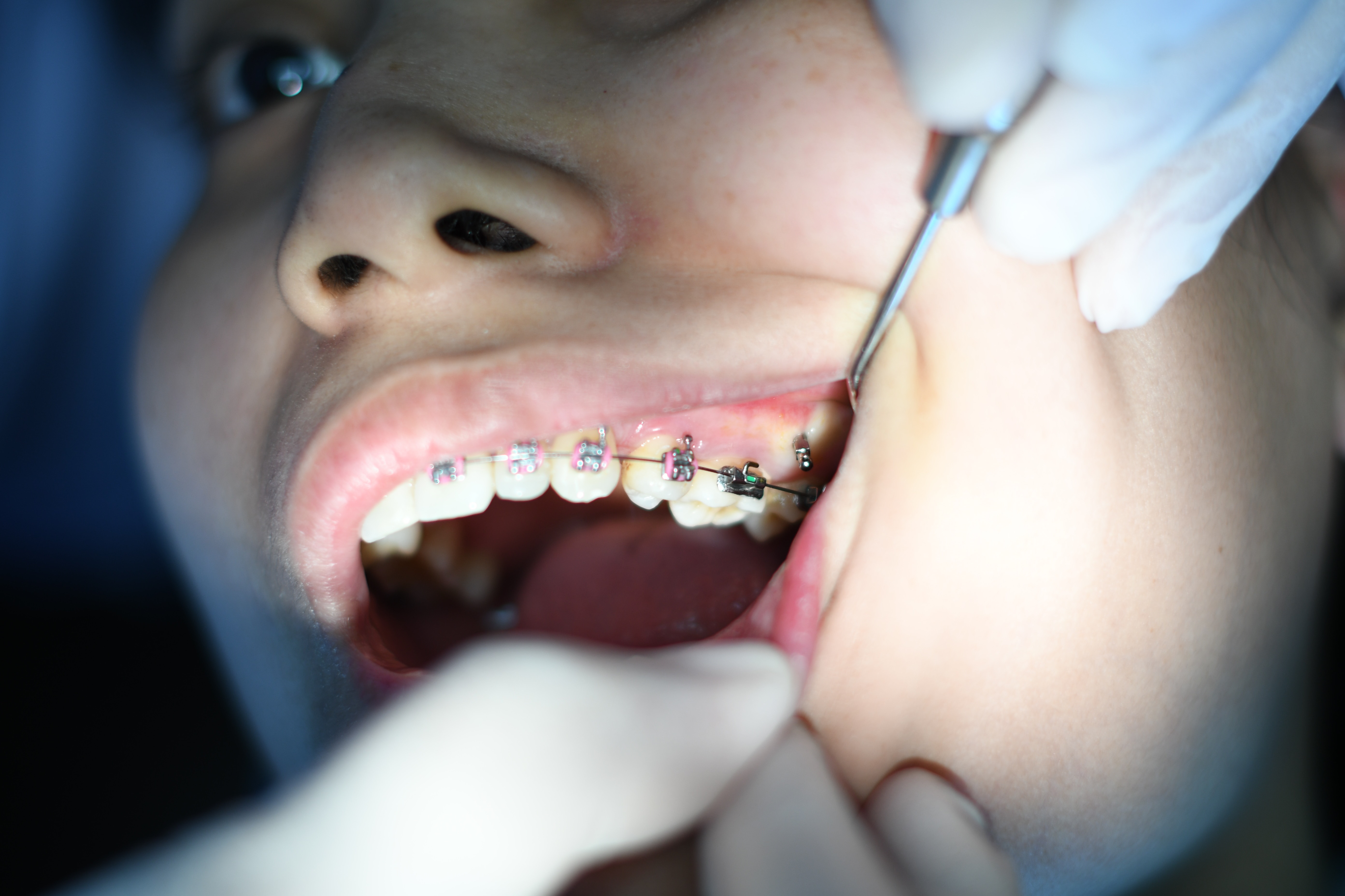 Orthodontist Wants to Pull My Child's Teeth: What to Do