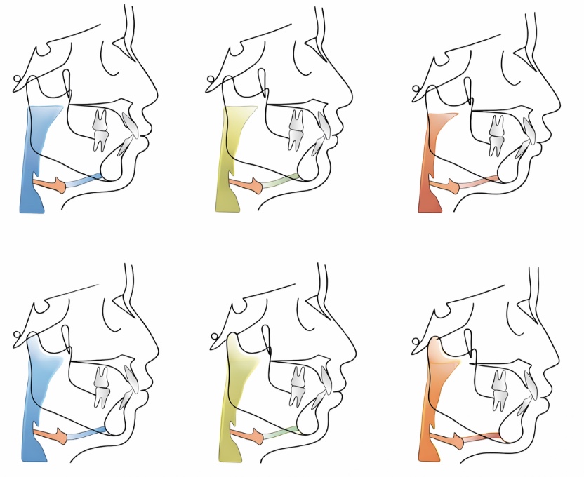 Why Do Teeth Shift After Braces? It Is a Force Problem