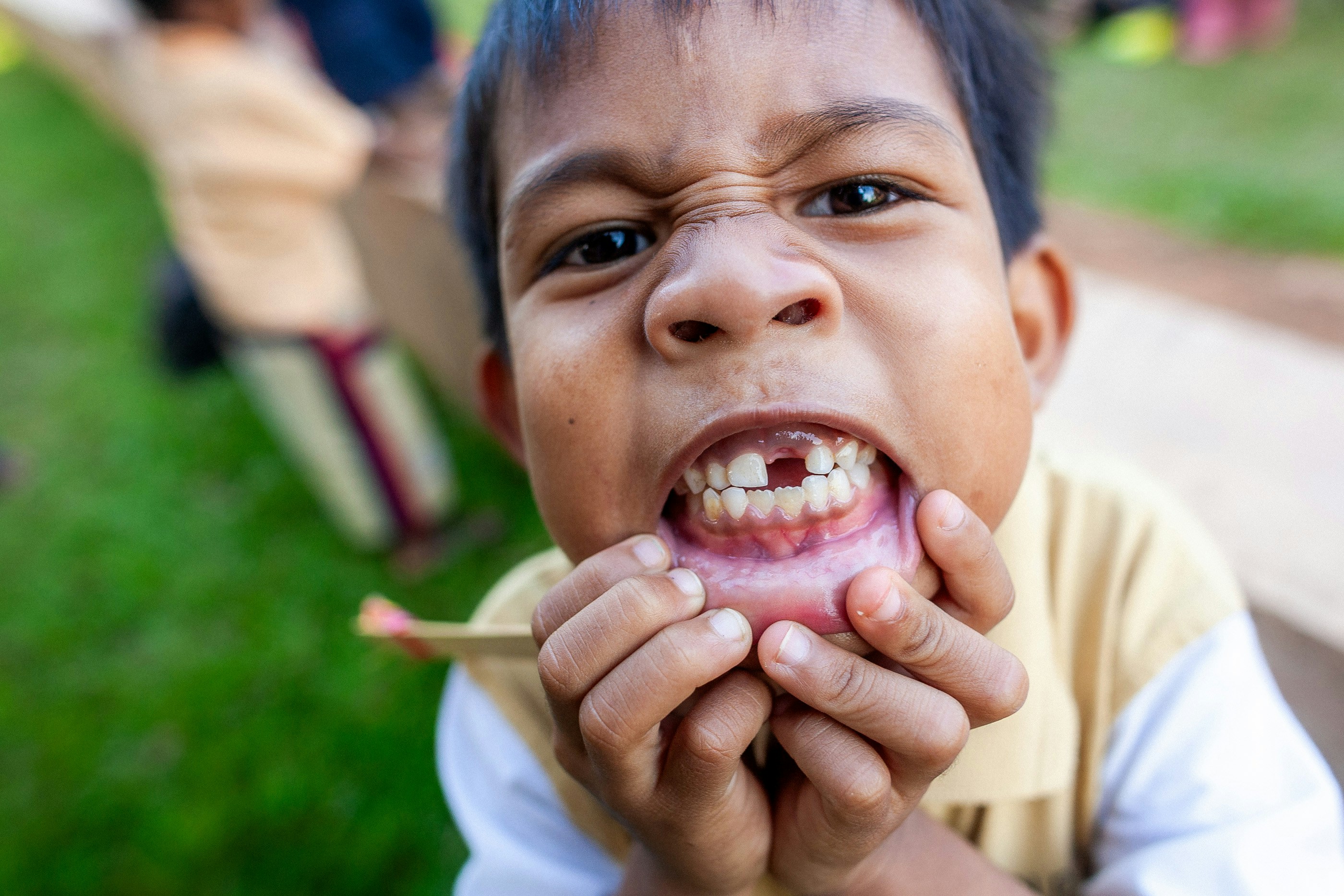 Does My Child Need a Space Maintainer After Losing a Tooth?